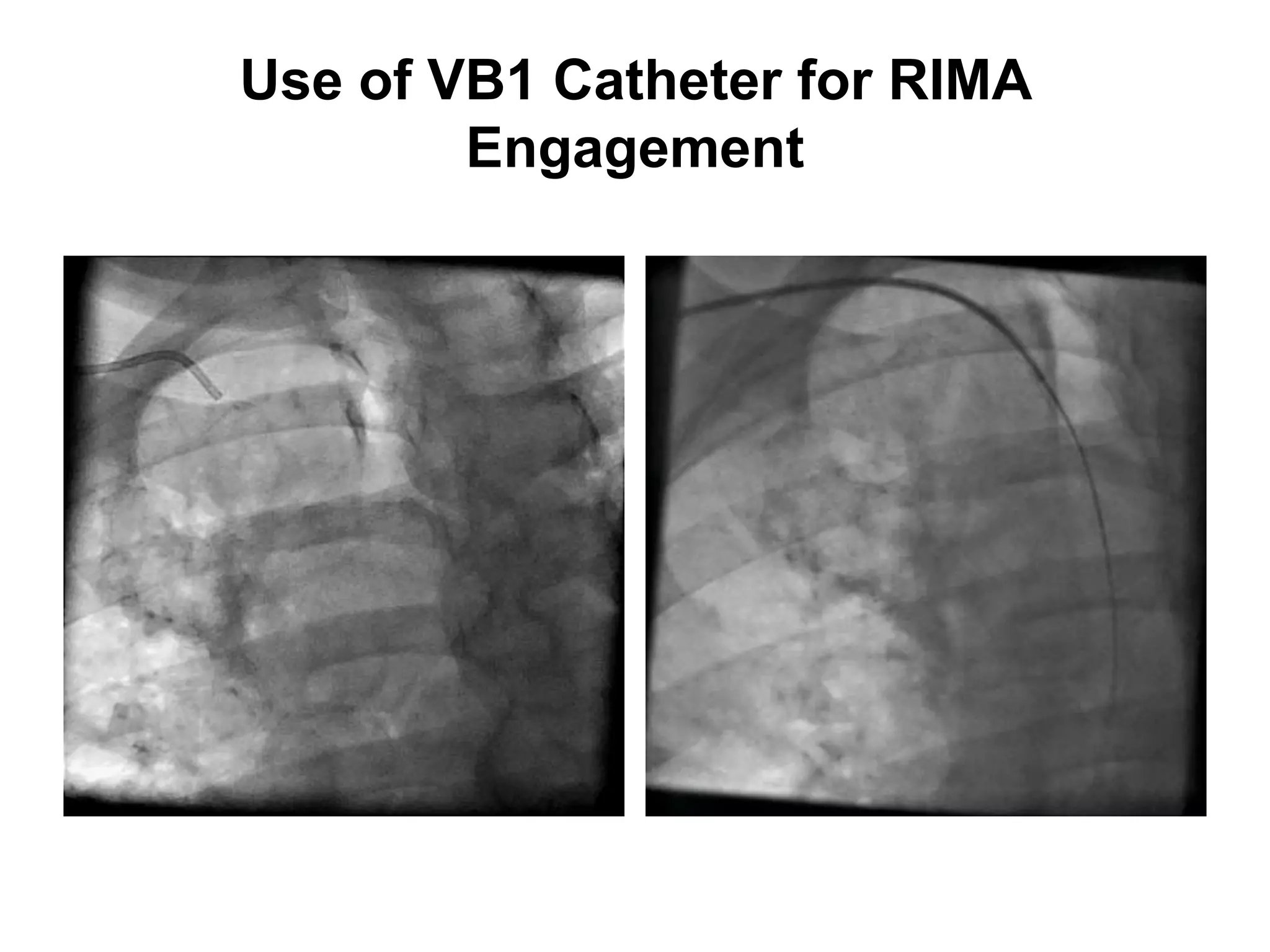 03 technical Cohen aimradial20170922 Guiding catheters | PPTX