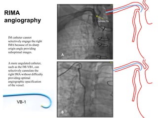 03 technical Cohen aimradial20170922 Guiding catheters | PPTX