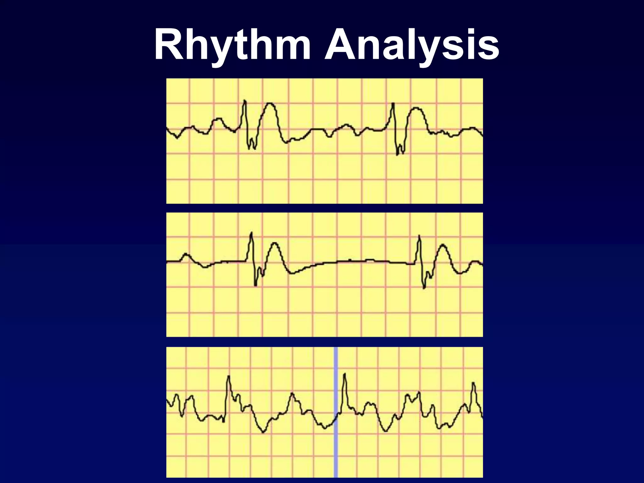 Rhythm Analysis
 