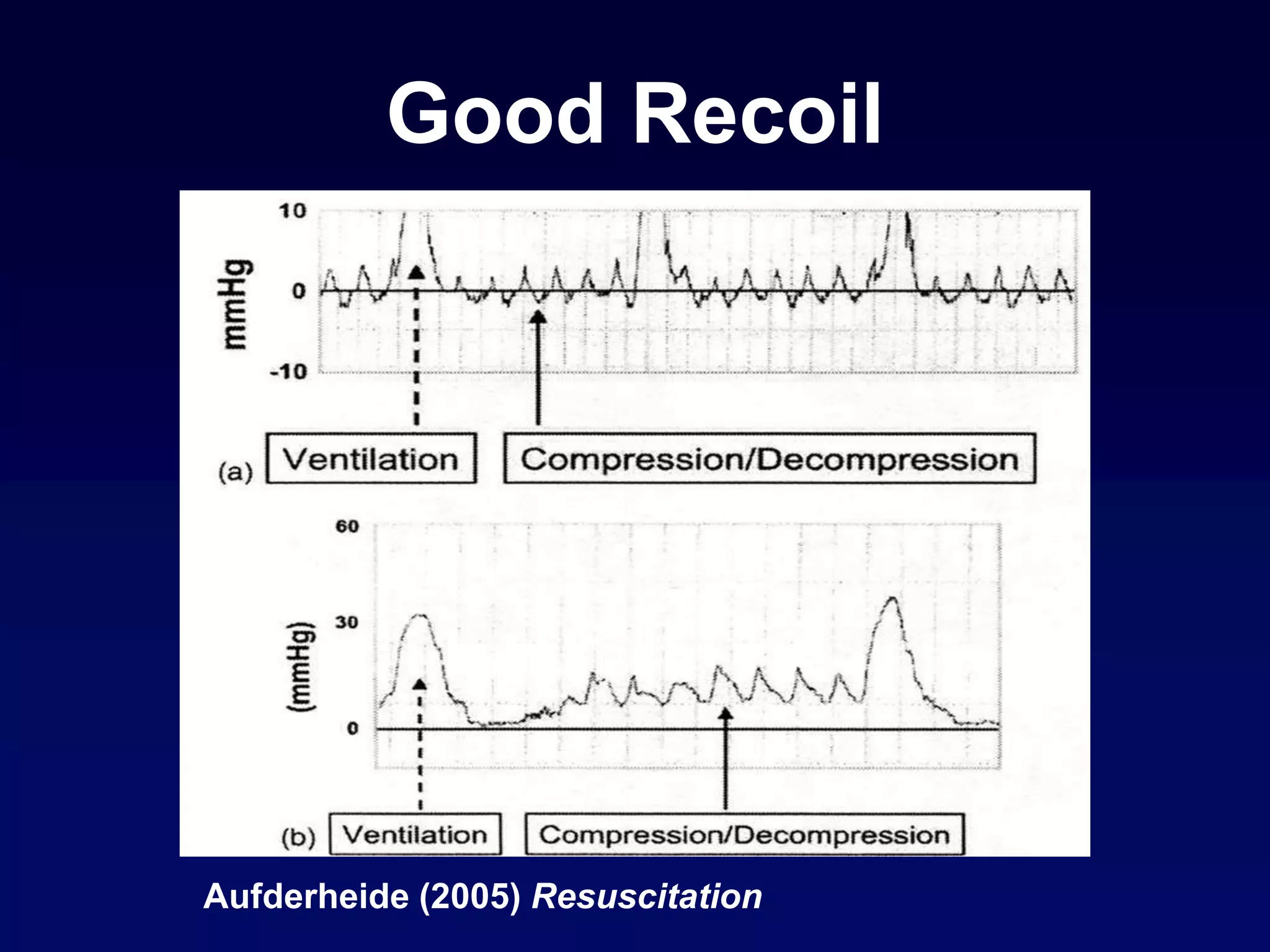 Aufderheide (2005) Resuscitation
Good Recoil
 