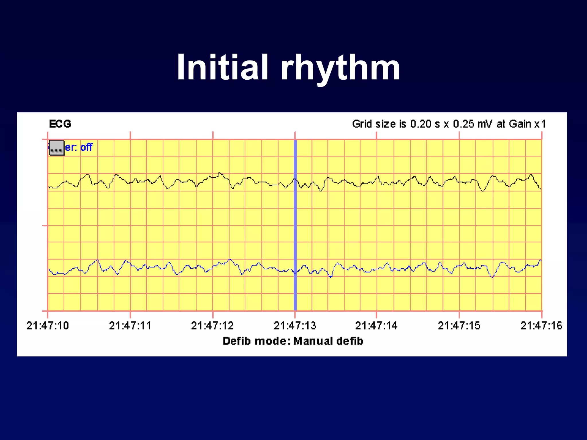 Initial rhythm
 
