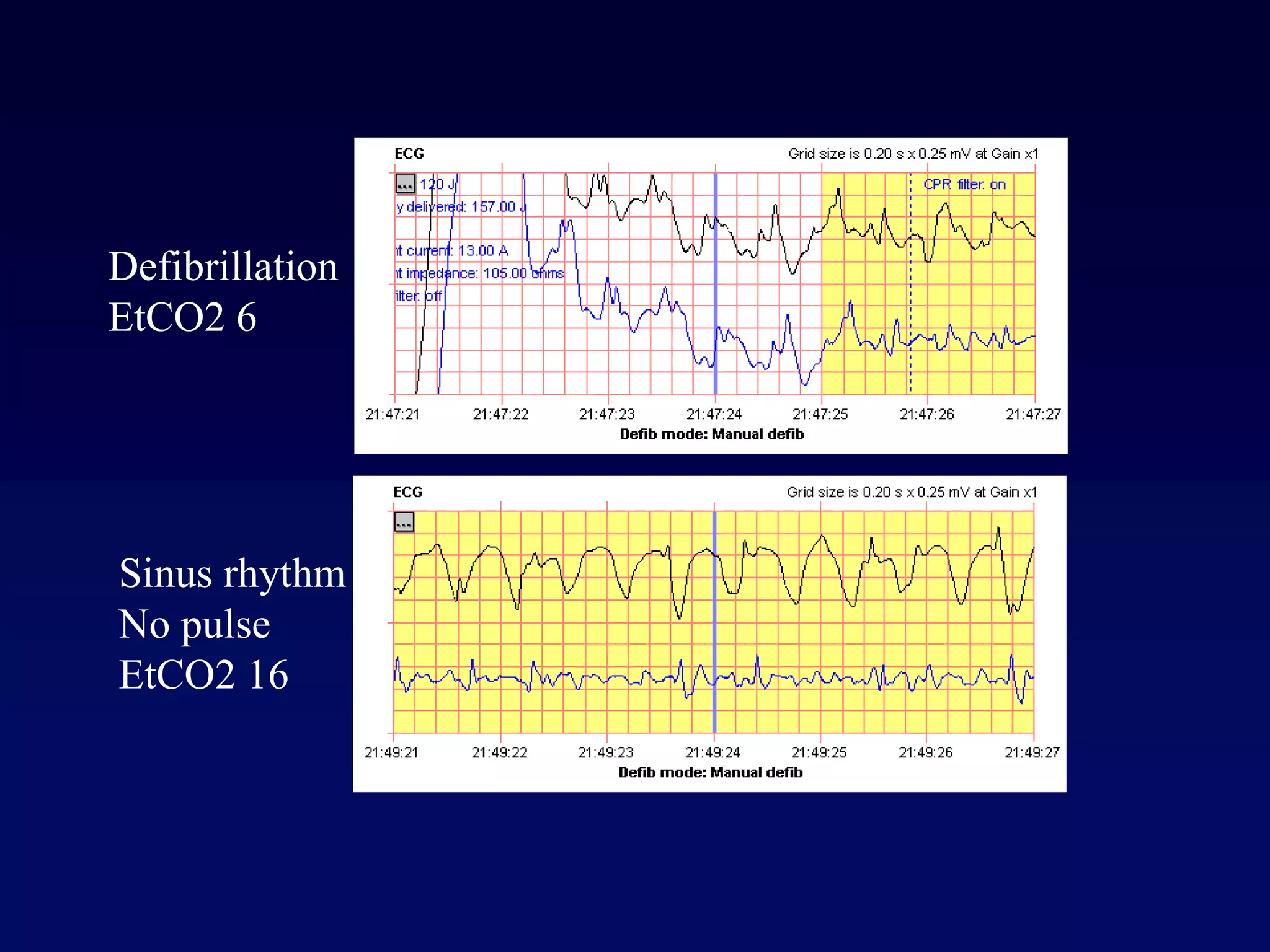 Defibrillation
EtCO2 6
Sinus rhythm
No pulse
EtCO2 16
 