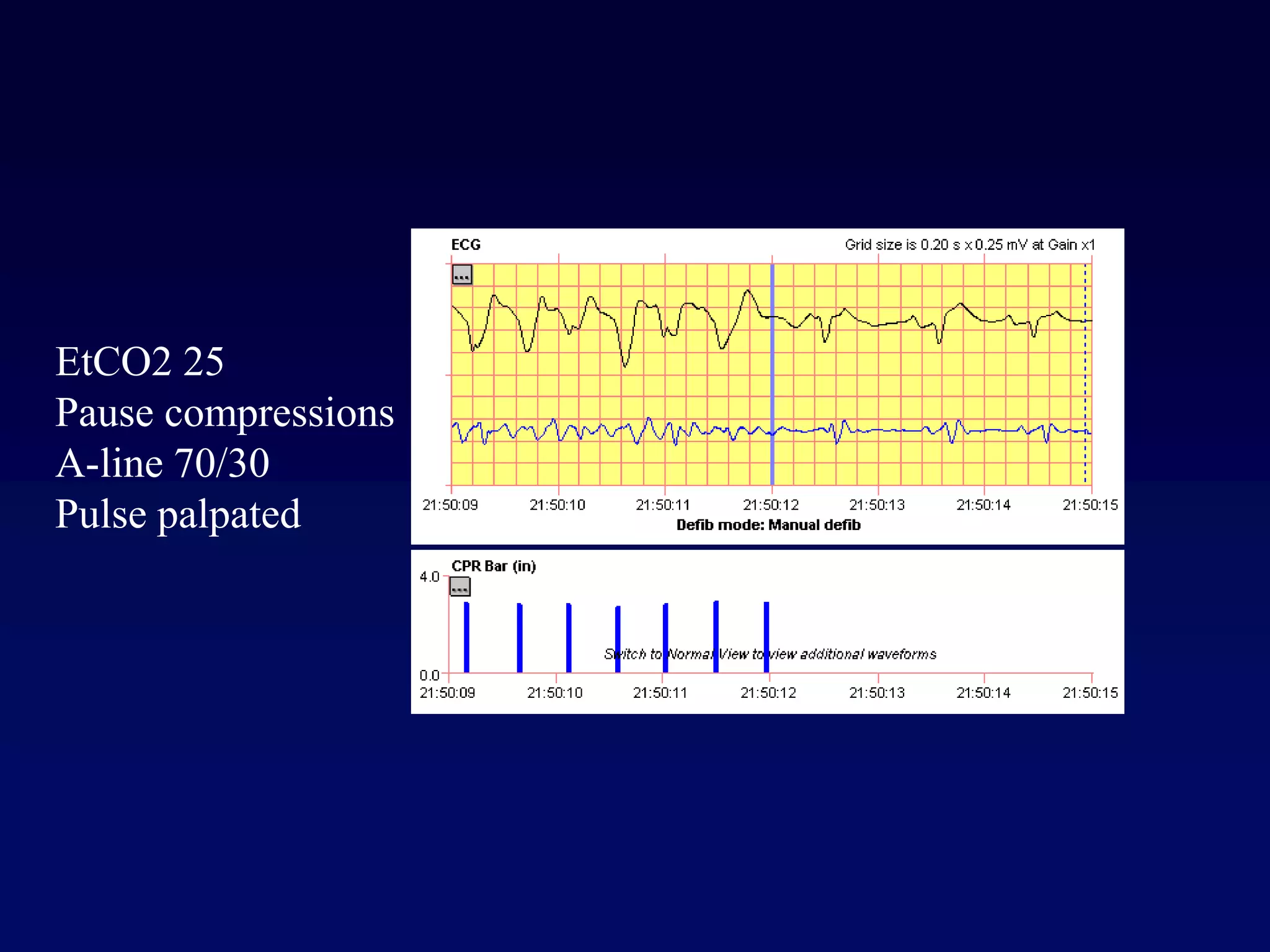 EtCO2 25
Pause compressions
A-line 70/30
Pulse palpated
 