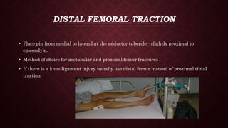 Distal Traction Rotation 03 traction ppt | PPTX