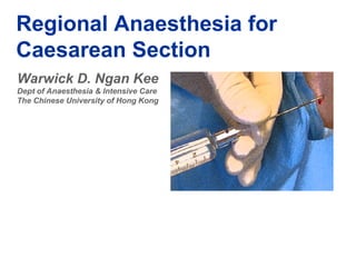 Regional Anaesthesia for 
Caesarean Section 
Warwick D. Ngan Kee 
Dept of Anaesthesia & Intensive Care 
The Chinese University of Hong Kong 
 