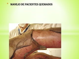 MAMEJO DE PACINETES QUEMADOS
* MANEJO DE PACIENTES QUEMADOS
 