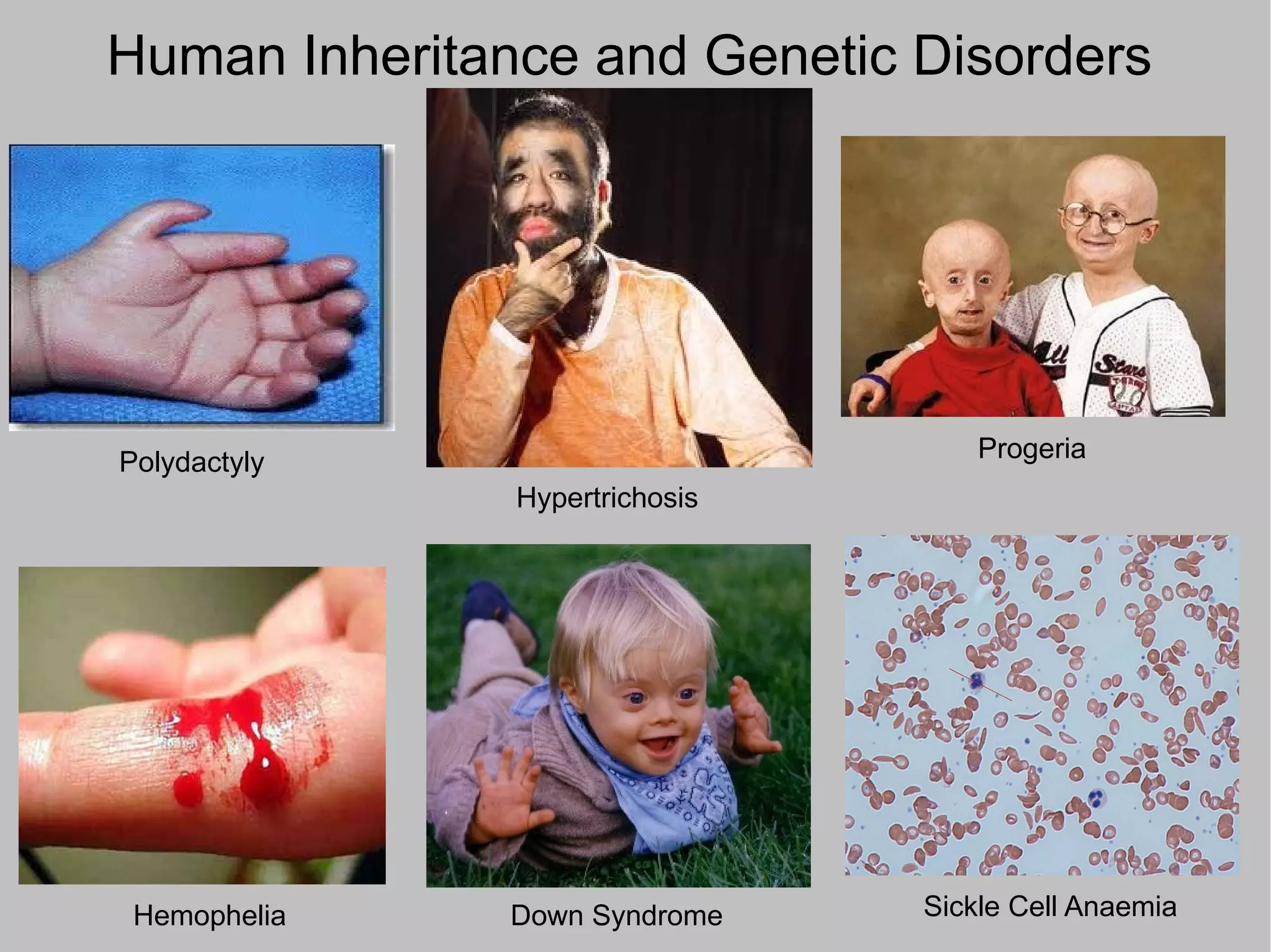Human inheritance genetic disorders ppt