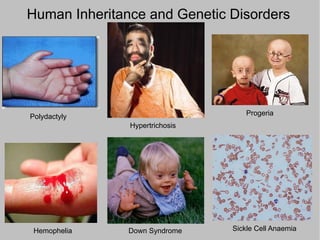 Human Inheritance and Genetic Disorders




Polydactyly                         Progeria
               Hypertrichosis




 Hemophelia    Down Syndrome    Sickle Cell Anaemia
 