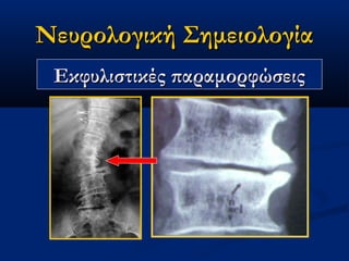 Νευρολογική ΣημειολογίαΝευρολογική Σημειολογία
Εκφυλιστικές παραμορφώσειςΕκφυλιστικές παραμορφώσεις
 
