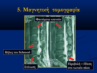 5. Μαγνητική5. Μαγνητική τομογραφίατομογραφία
ΠροβολήΠροβολή –– ΠίεσηΠίεση
στο νωτιαίο σάκοστο νωτιαίο σάκο
Φαινόμενο «κενού»Φαινόμενο «κενού»
ΣτένωσηΣτένωση
Κήλες τουΚήλες του SchmorlSchmorl
 