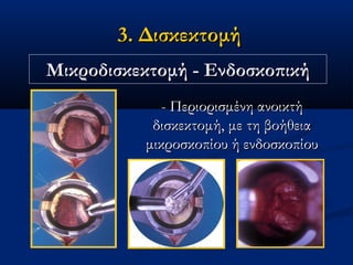 3. Δισκεκτομή3. Δισκεκτομή
ΜικροδισκεκτομήΜικροδισκεκτομή - Ενδοσκοπική- Ενδοσκοπική
- Περιορισμένη ανοικτή- Περιορισμένη ανοικτή
δισκεκτομή, με τη βοήθειαδισκεκτομή, με τη βοήθεια
μικροσκοπίου ή ενδοσκοπίουμικροσκοπίου ή ενδοσκοπίου
 