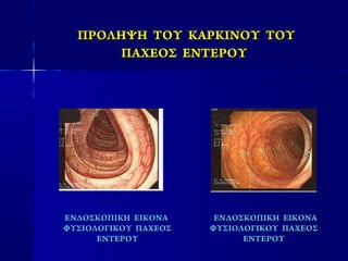 ΠΡΟΛΗΨΗ ΤΟΥ ΚΑΡΚΙΝΟΥ ΤΟΥΠΡΟΛΗΨΗ ΤΟΥ ΚΑΡΚΙΝΟΥ ΤΟΥ
ΠΑΧΕΟΣΠΑΧΕΟΣ ΕΝΤΕΡΟΥΕΝΤΕΡΟΥ
ΕΝΔΟΣΚΟΠΙΚΗΕΝΔΟΣΚΟΠΙΚΗ ΕΙΚΟΝΑΕΙΚΟΝΑ
ΦΥΣΙΟΛΟΓΙΚΟΥ ΠΑΧΕΟΣΦΥΣΙΟΛΟΓΙΚΟΥ ΠΑΧΕΟΣ
ΕΝΤΕΡΟΥΕΝΤΕΡΟΥ
ΕΝΔΟΣΚΟΠΙΚΗΕΝΔΟΣΚΟΠΙΚΗ ΕΙΚΟΝΑΕΙΚΟΝΑ
ΦΥΣΙΟΛΟΓΙΚΟΥΦΥΣΙΟΛΟΓΙΚΟΥ ΠΑΧΕΟΣΠΑΧΕΟΣ
ΕΝΤΕΡΟΥΕΝΤΕΡΟΥ
 