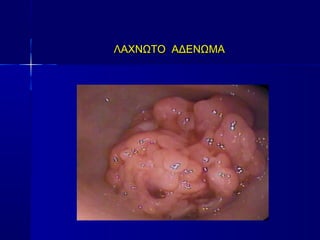 ΛΑΧΝΩΤΟ ΑΔΕΝΩΜΑΛΑΧΝΩΤΟ ΑΔΕΝΩΜΑ
 