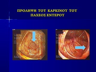 ΠΡΟΛΗΨΗ ΤΟΥ ΚΑΡΚΙΝΟΥ ΤΟΥΠΡΟΛΗΨΗ ΤΟΥ ΚΑΡΚΙΝΟΥ ΤΟΥ
ΠΑΧΕΟΣ ΕΝΤΕΡΟΥΠΑΧΕΟΣ ΕΝΤΕΡΟΥ
 