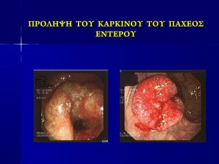 ΠΡΟΛΗΨΗ ΤΟΥ ΚΑΡΚΙΝΟΥ ΤΟΥ ΠΑΧΕΟΣΠΡΟΛΗΨΗ ΤΟΥ ΚΑΡΚΙΝΟΥ ΤΟΥ ΠΑΧΕΟΣ
ΕΝΤΕΡΟΥΕΝΤΕΡΟΥ
 