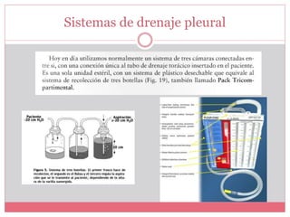 Sistemas de drenaje pleural
 