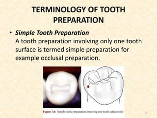 TERMINOLOGY OF TOOTH
PREPARATION
• Simple Tooth Preparation
A tooth preparation involving only one tooth
surface is termed simple preparation for
example occlusal preparation.
13
 