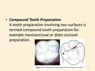 • Compound Tooth Preparation
A tooth preparation involving two surfaces is
termed compound tooth preparation for
example mesioocclusal or disto-occlusal
preparation.
14
 