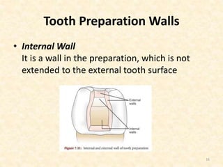 Tooth Preparation Walls
• Internal Wall
It is a wall in the preparation, which is not
extended to the external tooth surface
16
 
