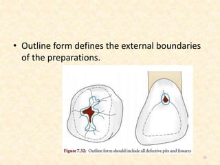 • Outline form defines the external boundaries
of the preparations.
25
 