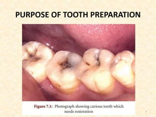 PURPOSE OF TOOTH PREPARATION
3
 