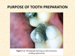 PURPOSE OF TOOTH PREPARATION
4
 