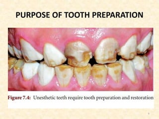 PURPOSE OF TOOTH PREPARATION
6
 