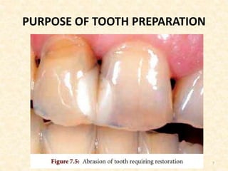 PURPOSE OF TOOTH PREPARATION
7
 