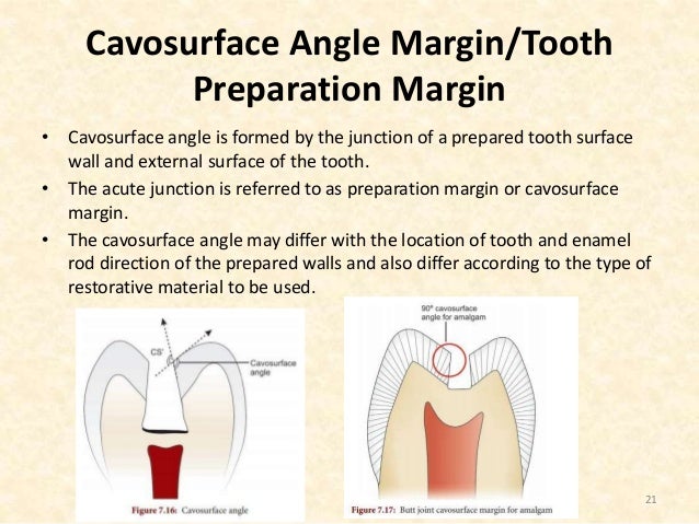 04 Principles Of Tooth Preparation