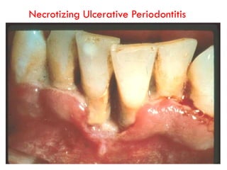 Necrotizing Ulcerative Periodontitis
 