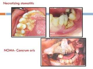Necrotizing stomatitis
NOMA- Cancrum oris
 