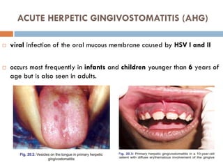 ACUTE HERPETIC GINGIVOSTOMATITIS (AHG)
 viral infection of the oral mucous membrane caused by HSV I and II
 occurs most frequently in infants and children younger than 6 years of
age but is also seen in adults.
 