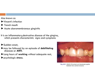 Also known as
►Vincent’s infection
► Trench mouth
► Acute ulceromembranous gingivitis
It is an inflammatory,destructive disease of the gingiva,
which presents characteristic signs and symptoms
►Sudden onset,
►may be followed by an episode of debilitating
diseases or ARTI.
►Long hours of working without adequate rest,
►psychologic stress.
 