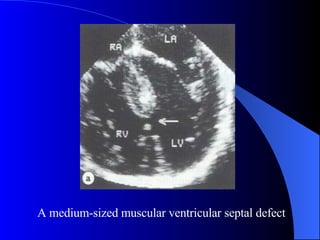 A medium-sized muscular ventricular septal defect 
