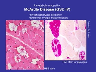 A metabolic myopathy:
McArdle Disease (GSD IV)
•Myophosphorylase deficiency
•Exertional myalgia, rhabdomyolysis
Courtesy
Ed
Bossen
PAS stain for glycogen
H&E stain
Glycogen storage disease.
Most servere form is Pompe's
disease which is GSD II
can cause kidney
failure. life
threatening
glycogen buildup
not all muscles are affected
 