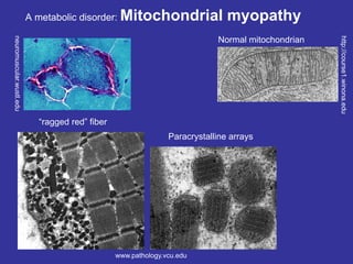 A metabolic disorder: Mitochondrial myopathy
www.pathology.vcu.edu
neuromuscular.wustl.edu
http://course1.winona.edu
Normal mitochondrian
“ragged red” fiber
Paracrystalline arrays
accumulation of
eosinophilic
material
mitochondria
accumulating in
sub-sarcolemma
space
called "parking lot
mitochondria".
sometimes you
will have normal
looking
mitochondria and
have disease
 