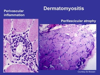 Courtesy Ed Bossen
Dermatomyositis
Perifascicular atrophy
Perivascular
inflammation due to loss of
capillaries because
of autoantibodies.
leads to formation
of immune
complexes which
damage the blood
vessels.
fibers on edges
shrink
fibers in the middle
stay the same size
 