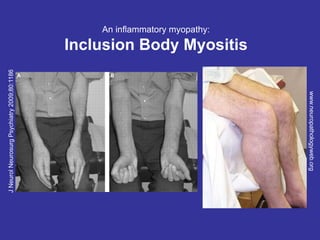 J
Neurol
Neurosurg
Psychiatry
2009;80:1186
www.neuropathologyweb.org
An inflammatory myopathy:
Inclusion Body Myositis
shows up in patients over 50. Degenerative disease in which there is
an accumulation of proteins in muscle over time. Body eventually
reacts against them.
finger flexor weakness
and intrinsic muscle
weakness quadricep atrophy and weakness
 