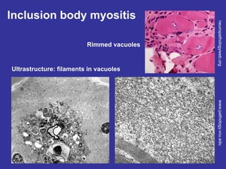 Inclusion body myositis
neuropathologyweb.org
www.pathology.vcu.edu
Rimmed vacuoles
Ultrastructure: filaments in vacuoles
inclusion body filaments are diagnostic feature
progressive disease. no cure. doesnt respond
to steroids.
 