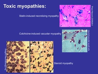 Statin-induced necrotizing myopathy
Colchicine-induced vacuolar myopathy
Steroid myopathy
neuromuscular.wustl.edu
Pract
Neurol
(2006)6:4
images.rheumatology.org
Toxic myopathies:
1-1.5% of people on statins
will develop myopathy. statins
have deleterious effect on
mitochondria. leads to muscle
weakness. Can cause
rhamdomyolysis. Can be life
threatening.
disappearance of
fibers.
macrophages
come in to clean it
up.
Colchicine is used to treat gout. affects
assembly of myofibrils
corticosteroids. type 2 fibers are
dark. selective atrophy of type 2
fibers
 