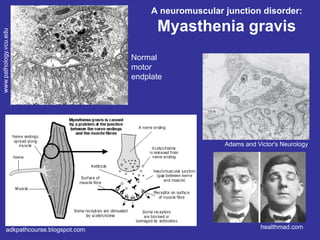 A neuromuscular junction disorder:
Myasthenia gravis
www.pathology.vcu.edu
Adams and Victor's Neurology
healthmad.com
adkpathcourse.blogspot.com
Normal
motor
endplate
autoimmune event which generate
antibodies to receptors on
postsynaptic membrane. prevents Ach
mediated muscle transport. Lambert
Eaton Syndrome doesnt respond to
AchE inhibitors because it affects
presynaptic agents
initially see ptosis, eyelid
drooping. effects reversed
by AchE inhibitors
abnormal motor
endplate
 