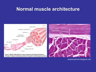 Normal muscle architecture
anatomyforme.blogspot.com
fascicle of
individual myocytes
longitudinal view
cross section view
Nucleus. Should be
peripheral like this in
normal muscle.
Myocytes should all
be about the same
size.
 