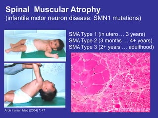 Spinal Muscular Atrophy
(infantile motor neuron disease: SMN1 mutations)
SMA Type 1 (in utero … 3 years)
SMA Type 2 (3 months … 4+ years)
SMA Type 3 (2+ years … adulthood)
Arch Iranian Med (2004) 7: 47
disease will depend on amount of loss of
SMN1 and how much SMN2 is present.
SMN2 can compensate for SNM1 loss
the earlier the disease arises, the more severe it is.
Children most affected will die of aspiration
pneumonia.
Pan fascicular
atrophy: entire
fascicle is
atrophied. Both
type 1 and type 2
will be atrophied
Compensatory
hypertrophy. Only
type 1 fibers.
 