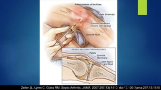 Zeller JL, Lynm C, Glass RM. Septic Arthritis. JAMA. 2007;297(13):1510. doi:10.1001/jama.297.13.1510
 
