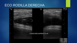 ECO RODILLA DERECHA
 