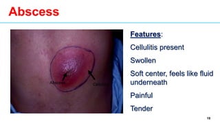 19
Abscess
Features:
Cellulitis present
Swollen
Soft center, feels like fluid
underneath
Painful
Tender
Cellulitis
Abscess
 
