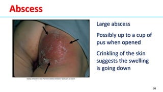 20
Abscess
Large abscess
Possibly up to a cup of
pus when opened
Crinkling of the skin
suggests the swelling
is going down
 