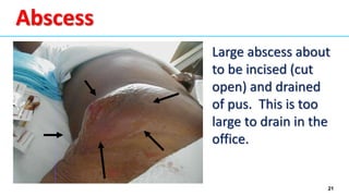 21
Abscess
Large abscess about
to be incised (cut
open) and drained
of pus. This is too
large to drain in the
office.
 