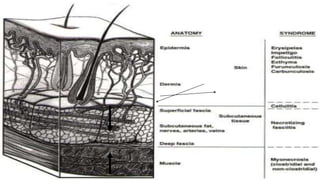 26
Necrotizing fasciitis
 