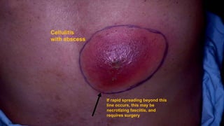 28
Cellulitis
with abscess
If rapid spreading beyond this
line occurs, this may be
necrotizing fasciitis, and
requires surgery
 